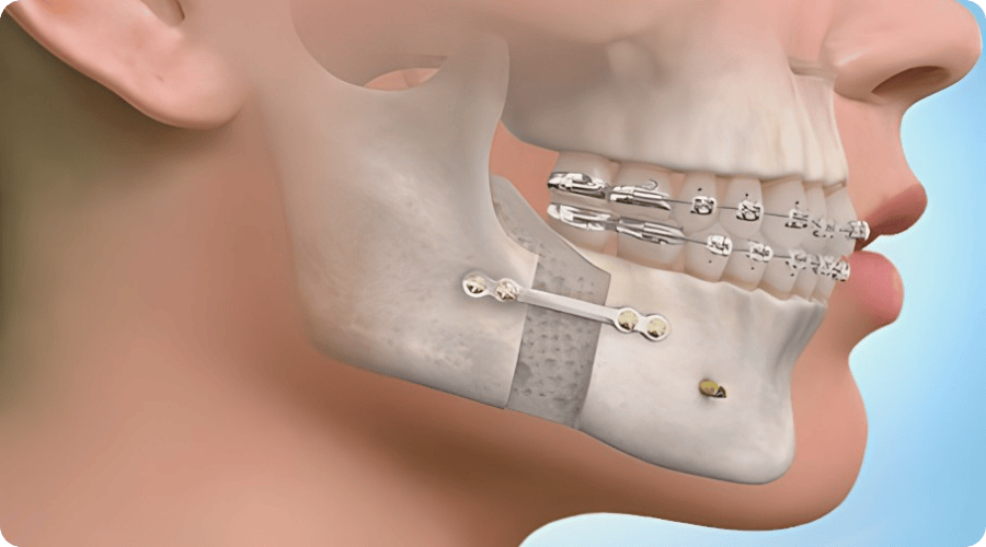 kadikoy ortognatik cerrahi tedavisi dr betul nazli