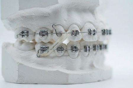 Diş teli lastiği takılı ortodontik braket modeli yakın çekim